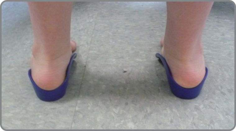 For Kids...Orthotics or Not?